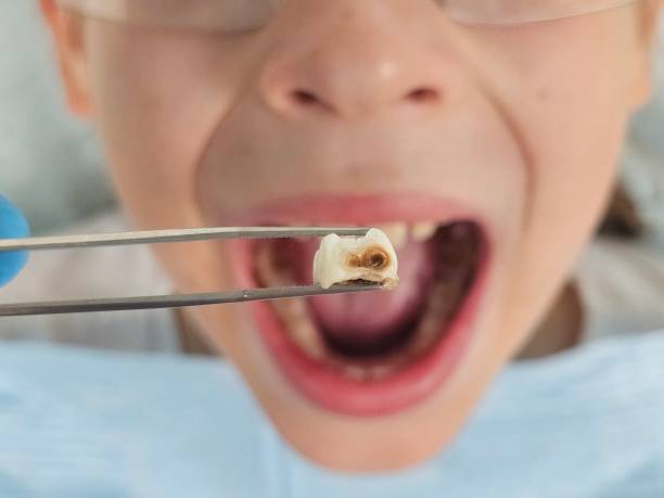 Best Emergency Dental Care for Broken or Chipped Teeth in Citrus Heights, CA